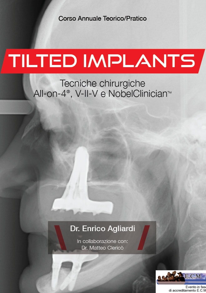 CORSO TILTED IMPLANT